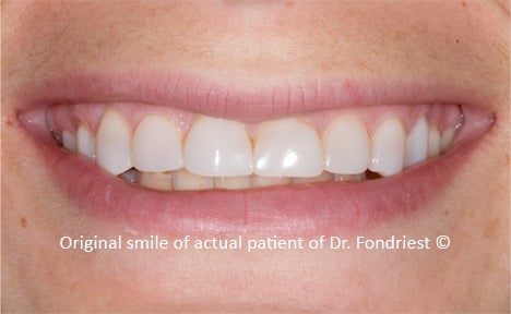 celiac enamel defects celiac enamel defects