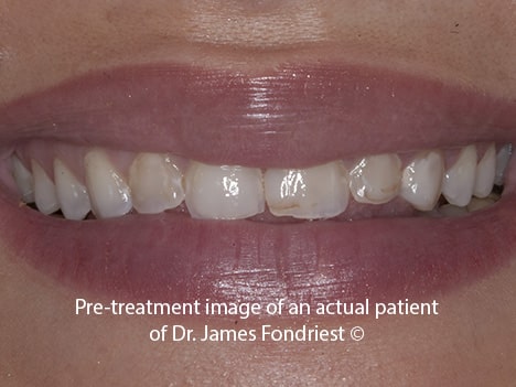 Stained unattractive teeth Stained unattractive teeth