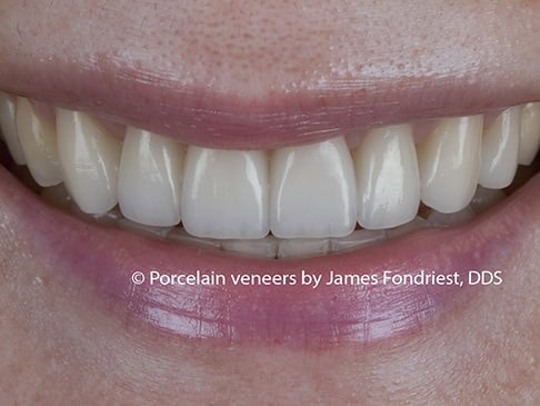 filling black triangles, veneers before and after filling black triangles, veneers before and after