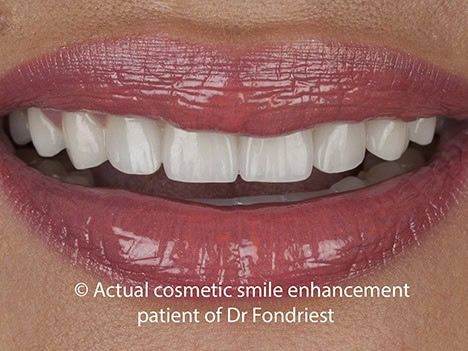 Porcelain veneers to replace bonding Porcelain veneers to replace bonding