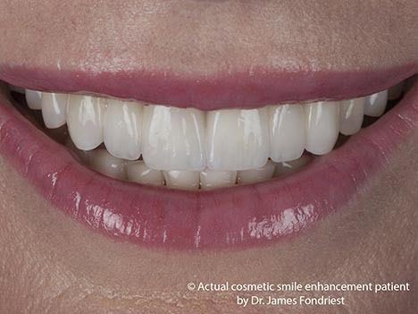 Zirconium dental bridgework, zirconium bridge, dental bridge before and after No space for implants