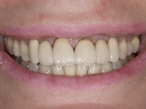 opaque porcelain bridgework, correction of angled teeth, unnatural dentistry bridges No space for implants
