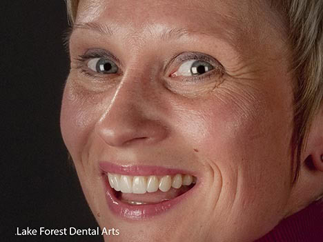 straighten teeth with veneers, veneers to shape teeth, Northfield resident straighten teeth with veneers, veneers to shape teeth, Northfield resident