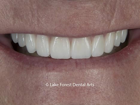 Prosthodontics for a better smile Prosthodontic restoration of smile