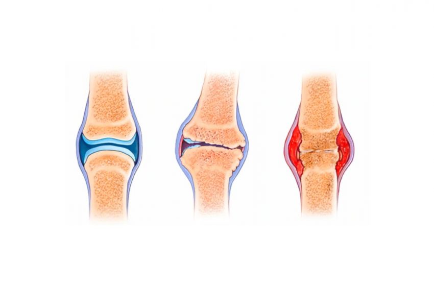 CBD for Loss of Joint Function