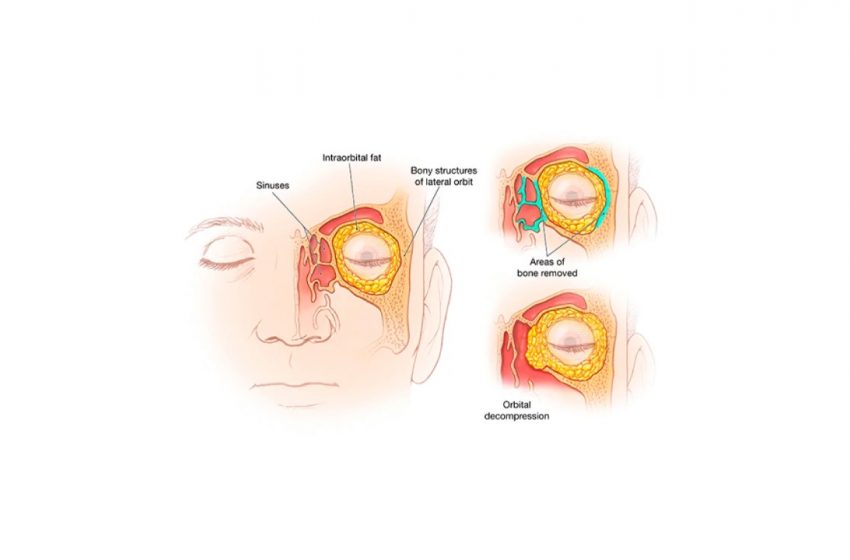Alleviating Symptoms of Graves Ophthalmopathy With CBD