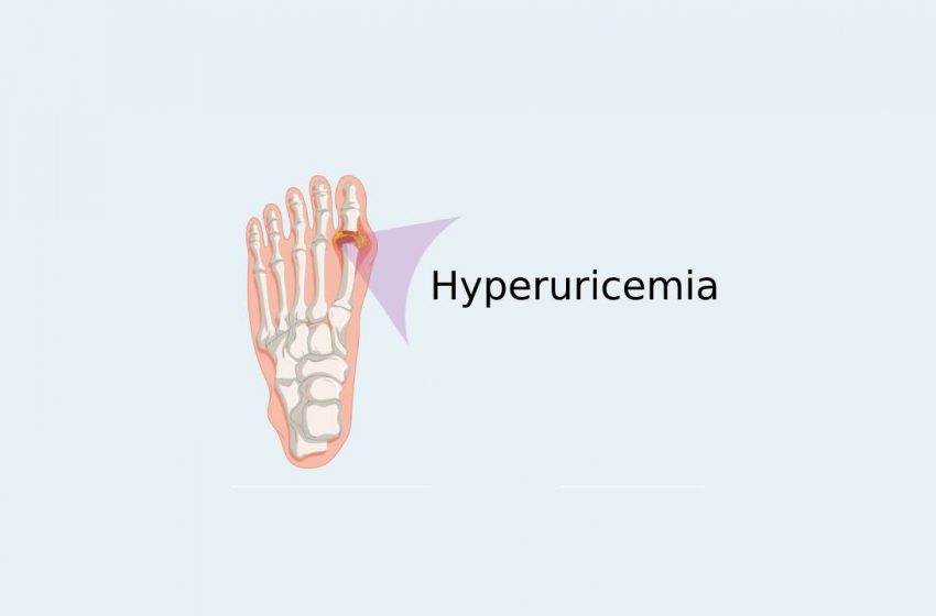 Is CBD Useful in Treating Asymptomatic Hyperuricemia?