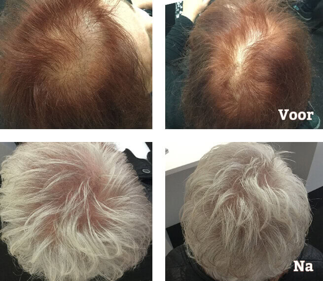 Haartransplantation Fur Frauen Acura Plastische Chirurgie