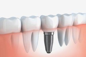 tooth replacement with dental implants