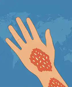 Hypnotherapy for psoriasis