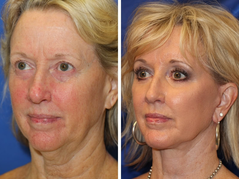 Before and After Face Fat Transfer