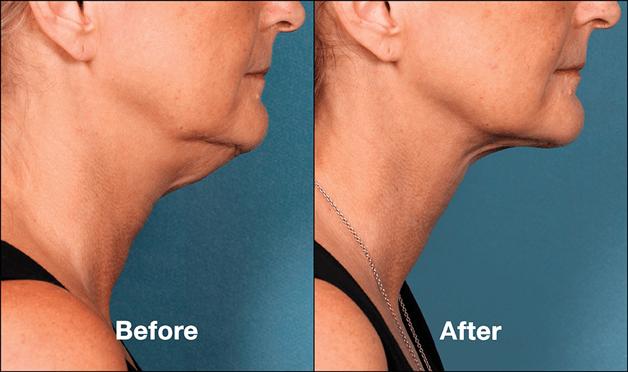 Kybella Patient PRI4 Before After (Side View)