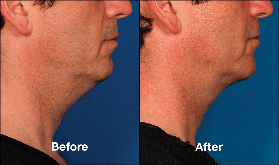 Kybella Patient PRI8 Before After (Side View)