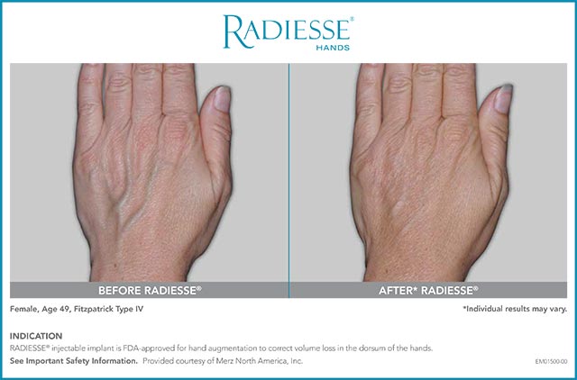 Radiesse Hands Patient Age 49