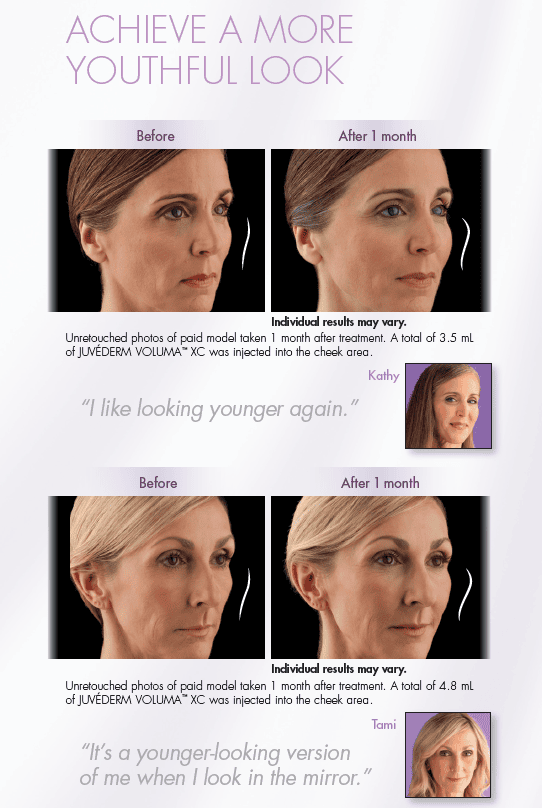 Voluma Juvederm Before and After
