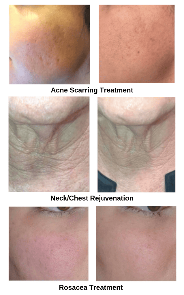 Aquagold Treatments Before & After