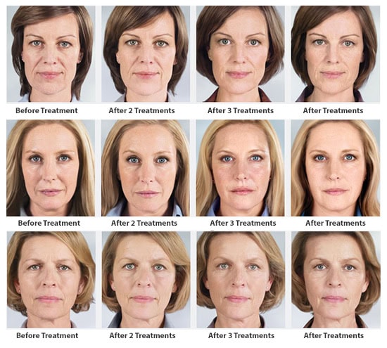 Before & After Sculptra