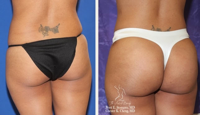 Brazilian Butt Lift