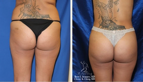 Brazilian Butt Lift 2