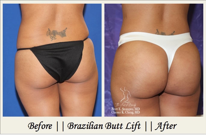 Brazilian Butt Lift P1