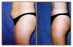 Liposuction