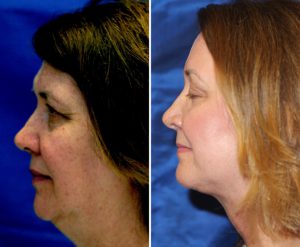 Liposuction Neck