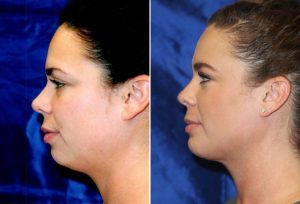 Neck Lipo