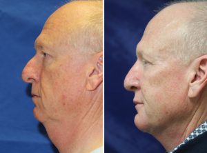 Neck Liposuction