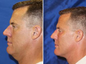 Neck Liposculpture