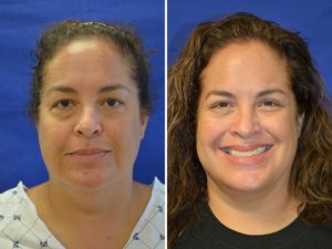 Neck Liposculpture