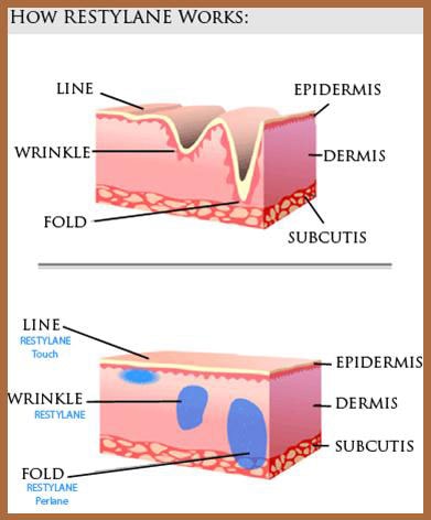 Restylane Information