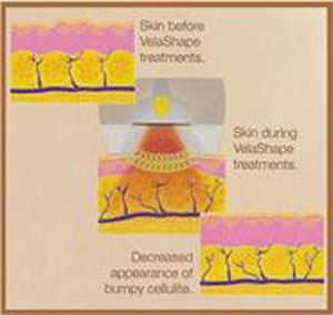 Velashape Image 1