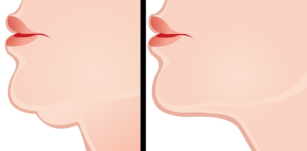 Exercícios Para Reduzir o Queixo Duplo Rápido | Dicas de Saúde
