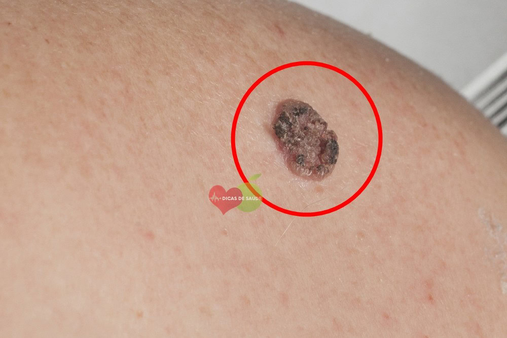 Carcinoma Basocelular - Causas, Sintomas e Tratamentos 1 | Dicas de Saúde
