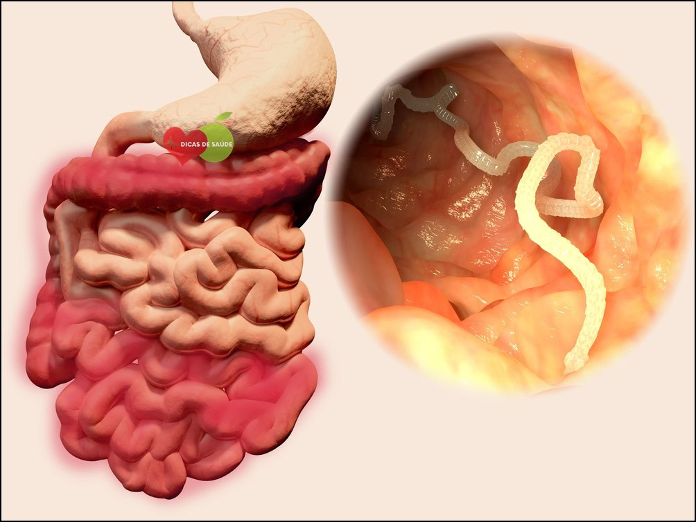 Como Eliminar Vermes Intestinais | Dicas de Saúde Como Eliminar Vermes Intestinais