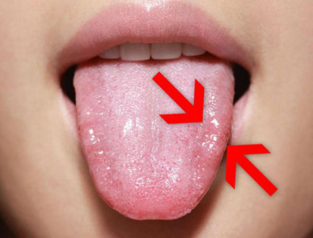 candidiase | Dicas de Saúde candidiase