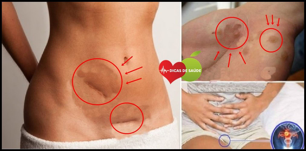 Sintomas de Infecção no Colo do Útero | Dicas de Saúde Principais Sintomas de Infecção no Colo do Útero