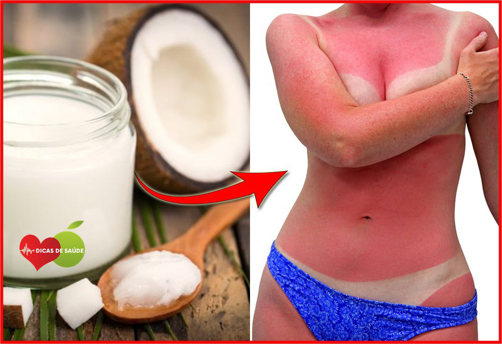 óleo de coco para queimaduras1~1 | Dicas de Saúde