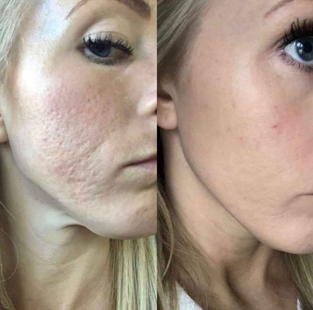 acne scarring - skin pen
