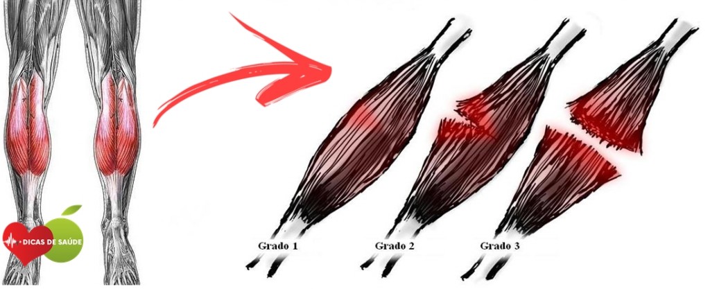 Distensão Muscular