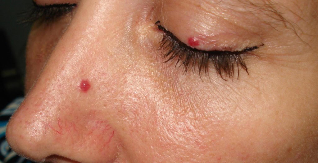 Angioma - Causas, Sintomas e Tratamentos | Dicas de Saúde Angioma