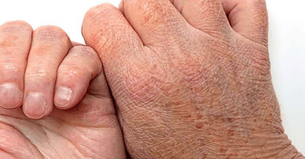 Doencas que a Pele Seca Pode Indicar | Dicas de Saúde