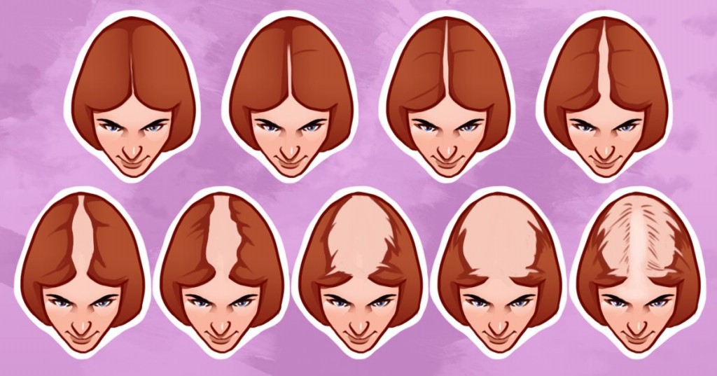 Perda de Cabelo | Dicas de Saúde