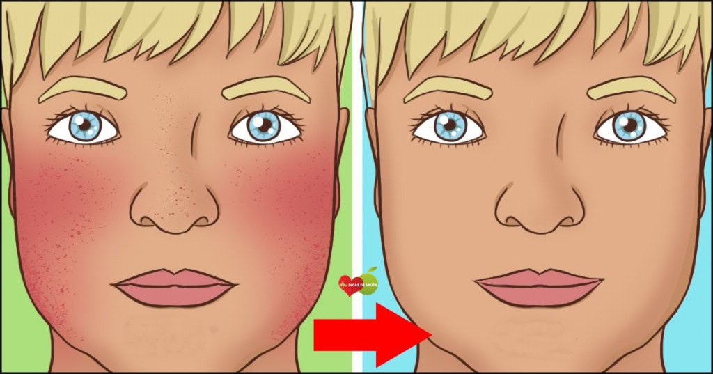 lupus | Dicas de Saúde