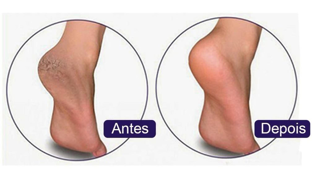 Receita Para Acabar com as Rachaduras nos Pés | Dicas de Saúde