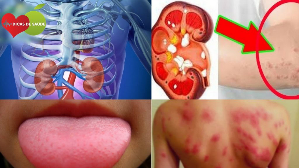 Sintomas que seu Rim Está em Perigo | Dicas de Saúde Sintomas que seu Rim Está em Perigo