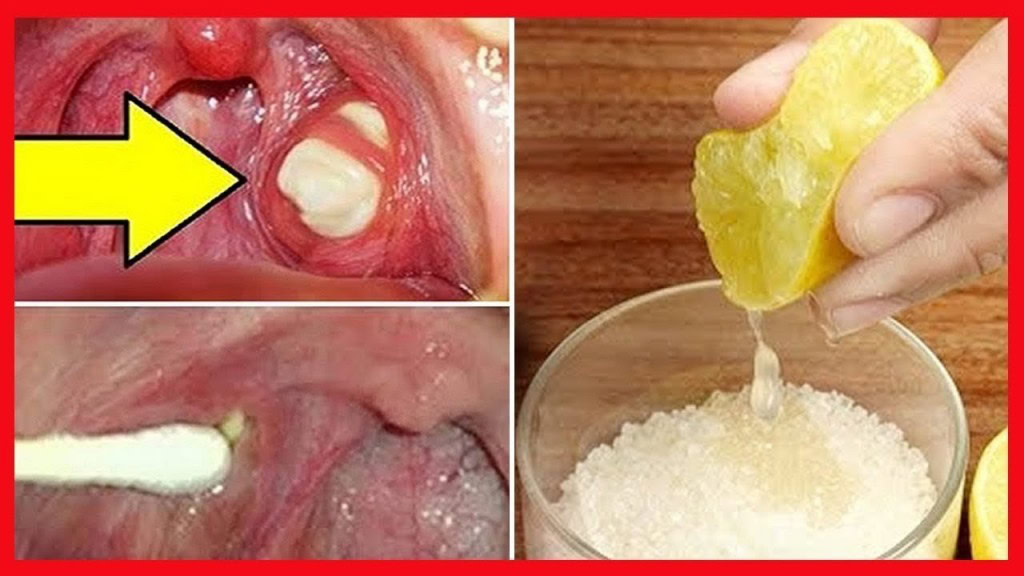 como curar o mau halito de forma natural | Dicas de Saúde como curar o mau halito de forma natural