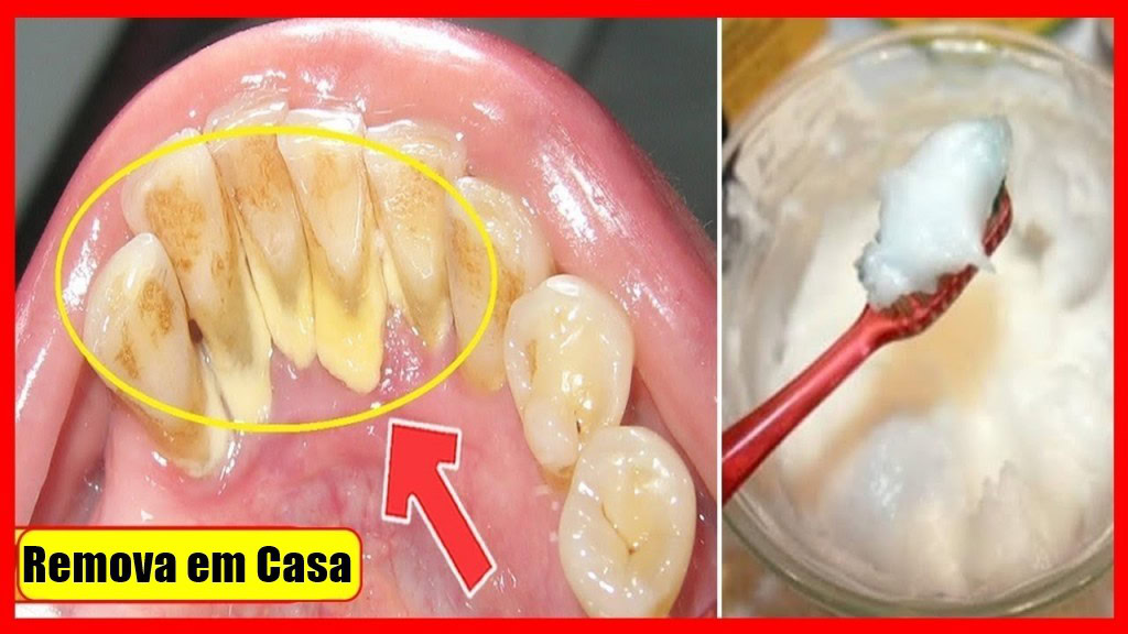 como eliminar o tartaro e clarear os dentes | Dicas de Saúde como eliminar o tartaro e clarear os dentes