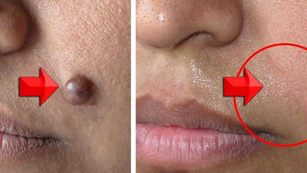 remover a verruga | Dicas de Saúde remover a verruga