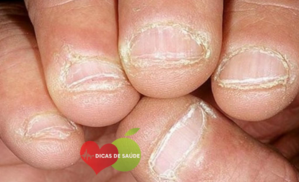 Deficiência de Vitamina B2 | Dicas de Saúde
